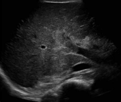 Update on Management of Portal Vein Thrombosis and the Role of Novel Anticoagulants