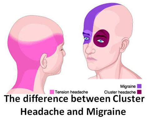 Cluster Headache Characteristics - YouMeMindBody