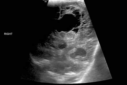 Grade IV germinal matrix hemorrhage with periventricular leukomalacia | Image | Radiopaedia.org