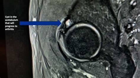 Hip Cysts | Acetabular Paralabral Cyst & Subchondral Cyst | FAI | Manhattan, New York City, NY