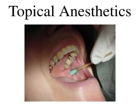 Local Anesthetic Side Effects Dentist at jonathanjtrewo blog