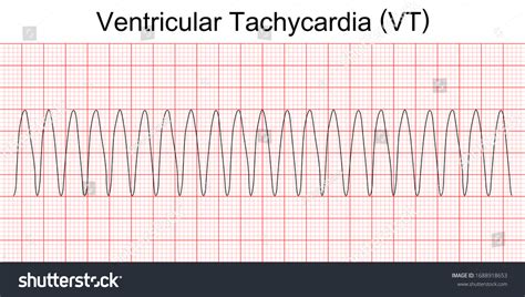 Polymorphic Ventricular Tachycardia Ecg