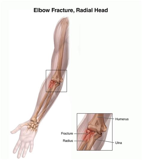 Radial Head Fractures | Hand2Shoulder Clinic