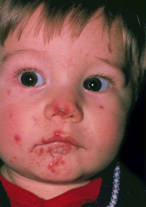 Impetigo & Ecthyma Treatment, Symptoms & Causes │Manuals - Dermatologic Disorders - MSD Manual ...