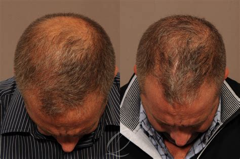 Male Crown Hair Restoration Before & After Photo Gallery | Rochester ...