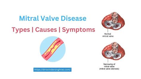 Mitral Valve Disease - Types, Causes and Symptoms