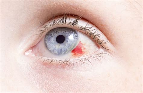 What Causes Broken Blood Vessels in the Eye? | Stony Plain