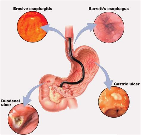 The Health Website : Gastric (Stomach) ulcer