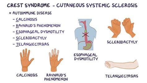 CREST syndrome - Osmosis