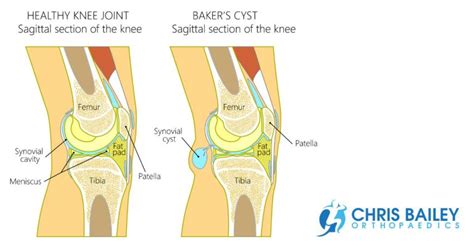 The Baker’s Cyst - Chris Bailey FB - Chris Bailey Orthopaedics