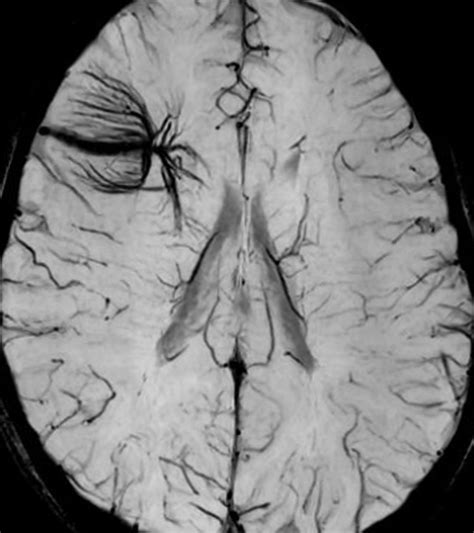 Developmental Venous Anomaly | The Neurosurgical Atlas