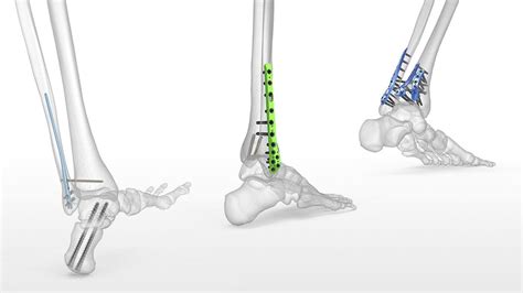 Types of Orthopedic Implants: Advantages & Disadvantages - Siiora ...