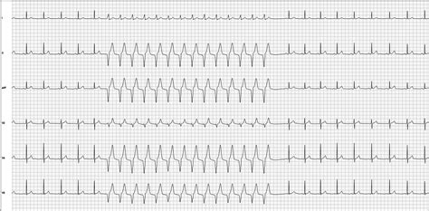 ECG Basics: Accelerated Idioventricular Rhythm | ECG Guru - Instructor ...