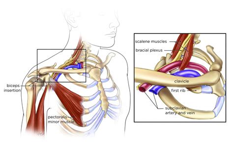 Thoracic Outlet Syndrome - Goodman Campbell