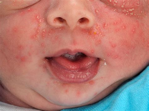 Erythema toxicum neonatorum (eosinophylicum)