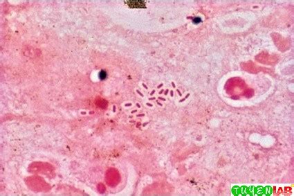 K. Pneumoniae Gram Stain