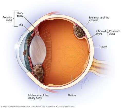 Melanoma ocular - Síntomas y causas - Mayo Clinic