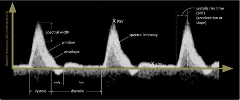 Spectral Doppler ultrasound of peripheral arteries: a pictorial review - Clinical Imaging