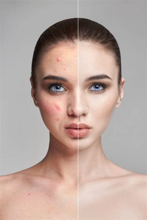 HOW TO DEAL WITH A BAD SKIN DAY | Medifine Skin Clinic