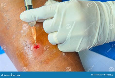 Abscess Wound. Royalty-Free Stock Image | CartoonDealer.com #74161822