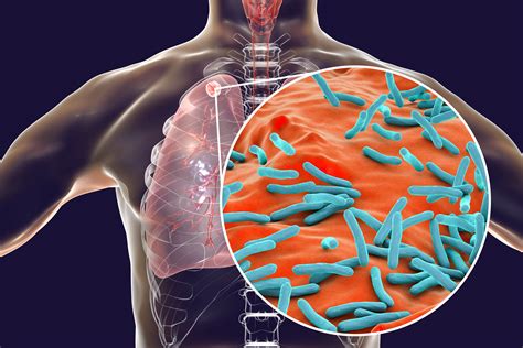 Type I IFN Exacerbates Disease in Tuberculosis Susceptible Mice by ...