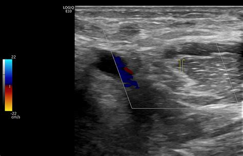 Isolated Radial Vein Thrombosis: Upper Extremity Deep Vein Thrombosis in a Patient With COVID-19 ...