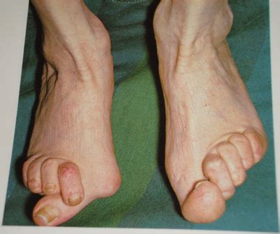 Callus on the foot pictures, arthritis feet