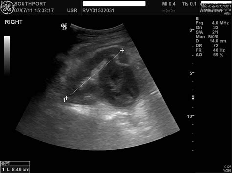 Pyonephrosis Ultrasound