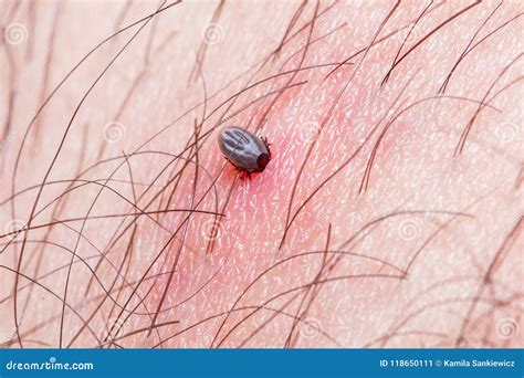 Tick biting human stock image. Image of health, blood - 118650111