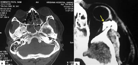 CT (axial cuts) scan (a) showing blow-in fracture of left lateral wall ...