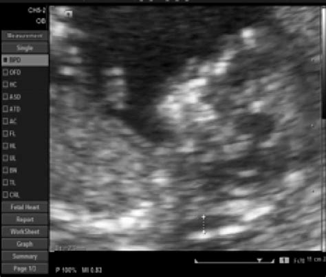 Ultrasound image of the fetus at 12 weeks, showing the nuchal ...