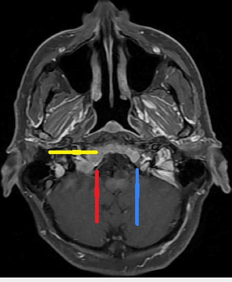 MRI revealing right hypoglossal canal narrowing due to diffuse bone ...