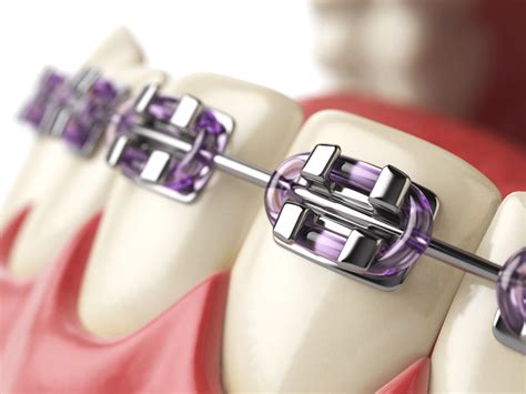 What Are the Most Affordable Braces? - M. Scott Runnels D.M.D., P.A.