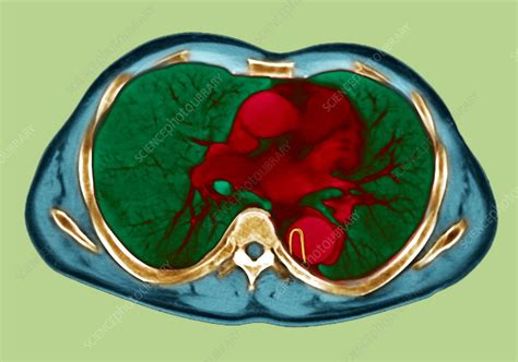 Aortic dissection, CT scan - Stock Image - M172/0546 - Science Photo ...