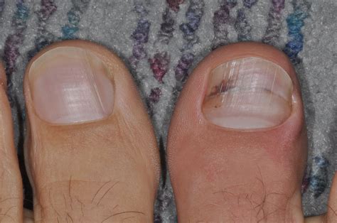 Black Spot On Toenail Near Cuticle - Nail Ftempo