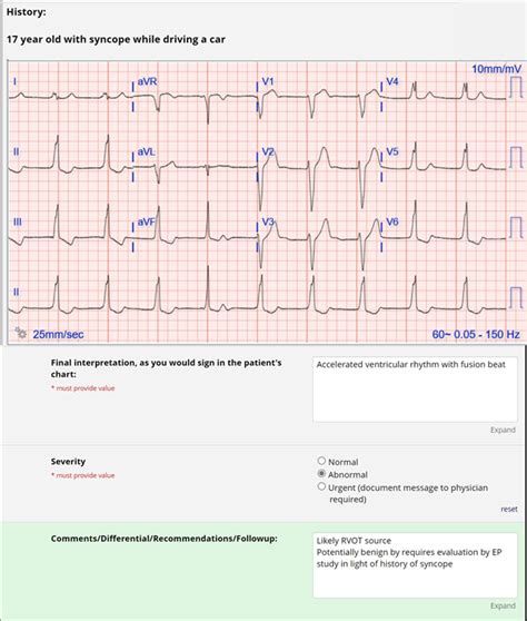 Pediatric ECG Examples | Johns Hopkins Children's Center Cardiology Research