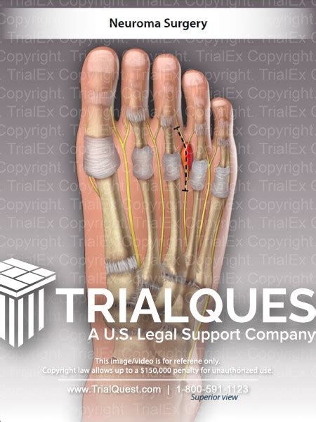 Neuroma Surgery - TrialExhibits Inc.