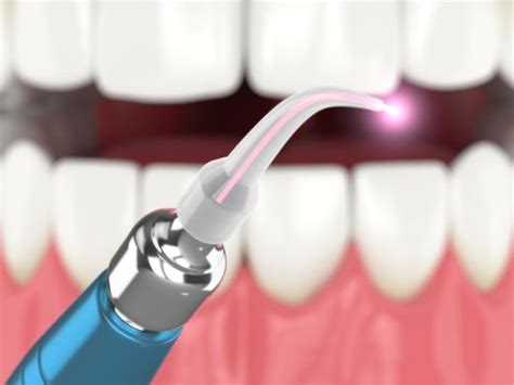 A Complete Guide to Laser Therapy for Gum Disease | Benjamin S. Fiss, D ...