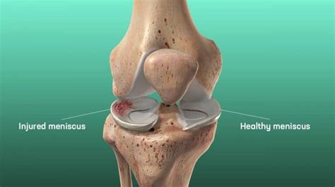 The Complete Guide to a Meniscus Tear | Kinetic Labs