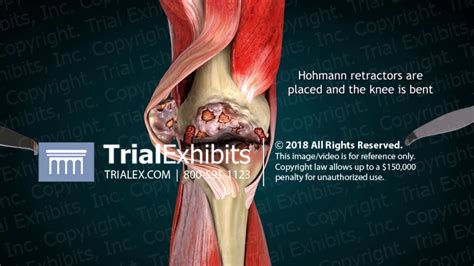 3D Animation of Right Total Knee Replacement - YouTube