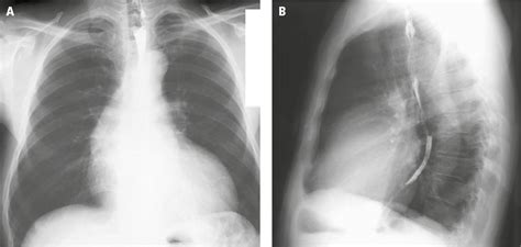 Figure 031_0852. Posteroanterior (PA; A ) and lateral ( B ) chest radiography: left ventricular ...