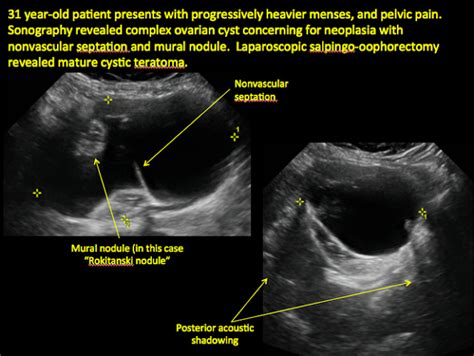 MEDICAL ULTRASOUND/OVARIAN TUMOR