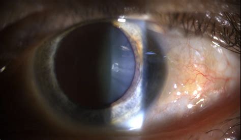 Pinguecula vs. Pterygium | LaptrinhX / News