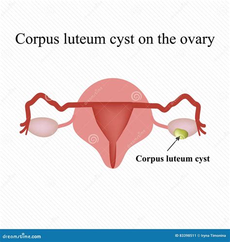 De Cyste Van Corpusluteum Op De Eierstok Functioneel Infographics Vector Illustratie Vector ...