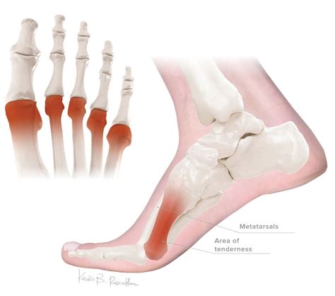 Orthoses Efficacy for Conditions – KevinRoot Medical