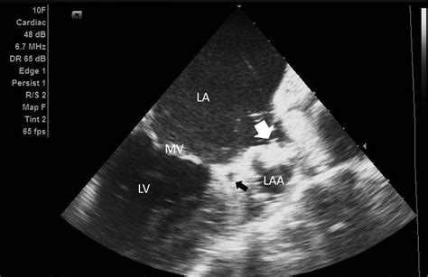 Left Atrial Appendage Closure Under Intracardiac Echocardiographic Guidance: Feasibility and ...