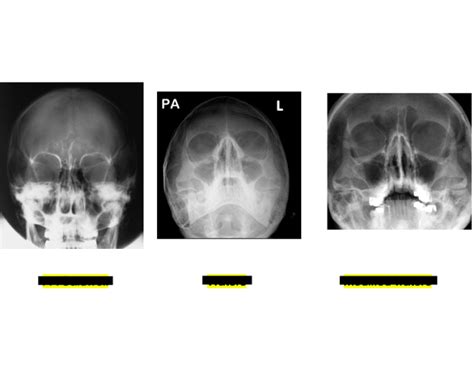 petrous ridges shown on facial images Quiz