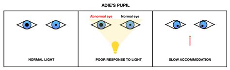 Anisocoria | Geeky Medics