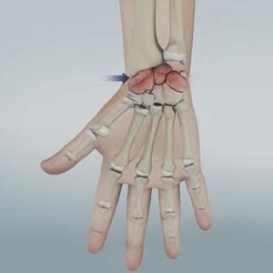 Wrist Arthritis Treatment NSW | Osteoarthritis Treatment NSW