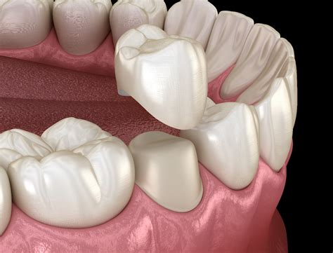 Illustration-of-dental-crown-being-placed-on-tooth - Anderson Family Dental